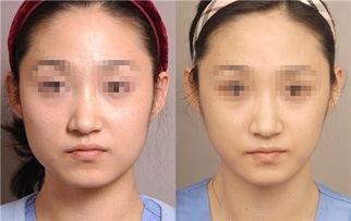 国产瘦脸针手法视频大全,轻松掌握瘦脸技巧